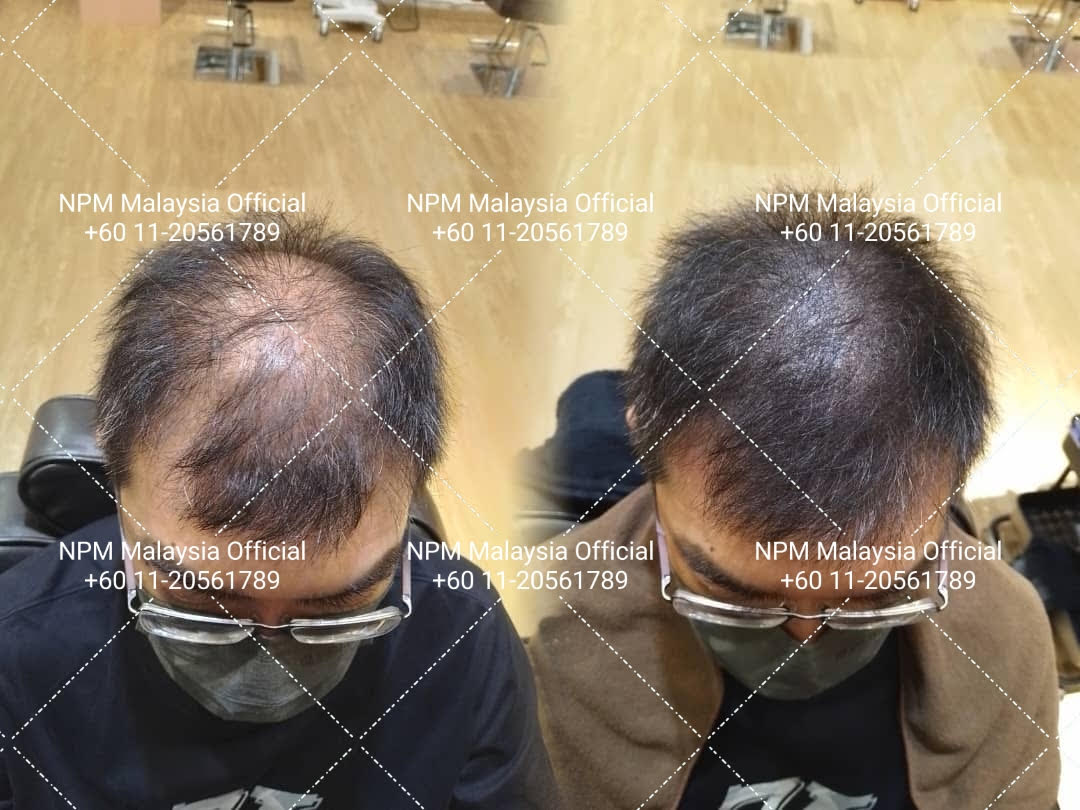 Before and after, hairline