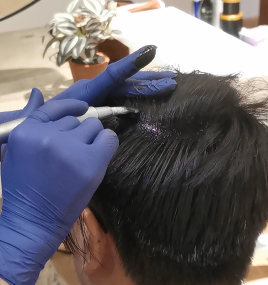 Treatment in progress on the scalp