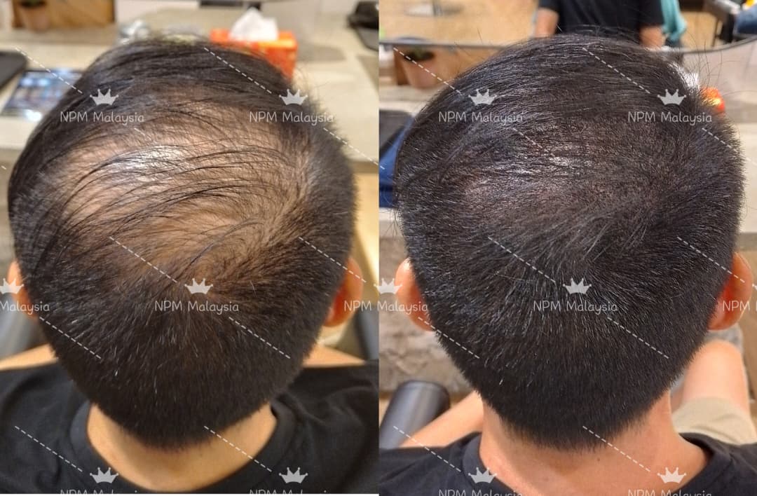 Before and after, crown