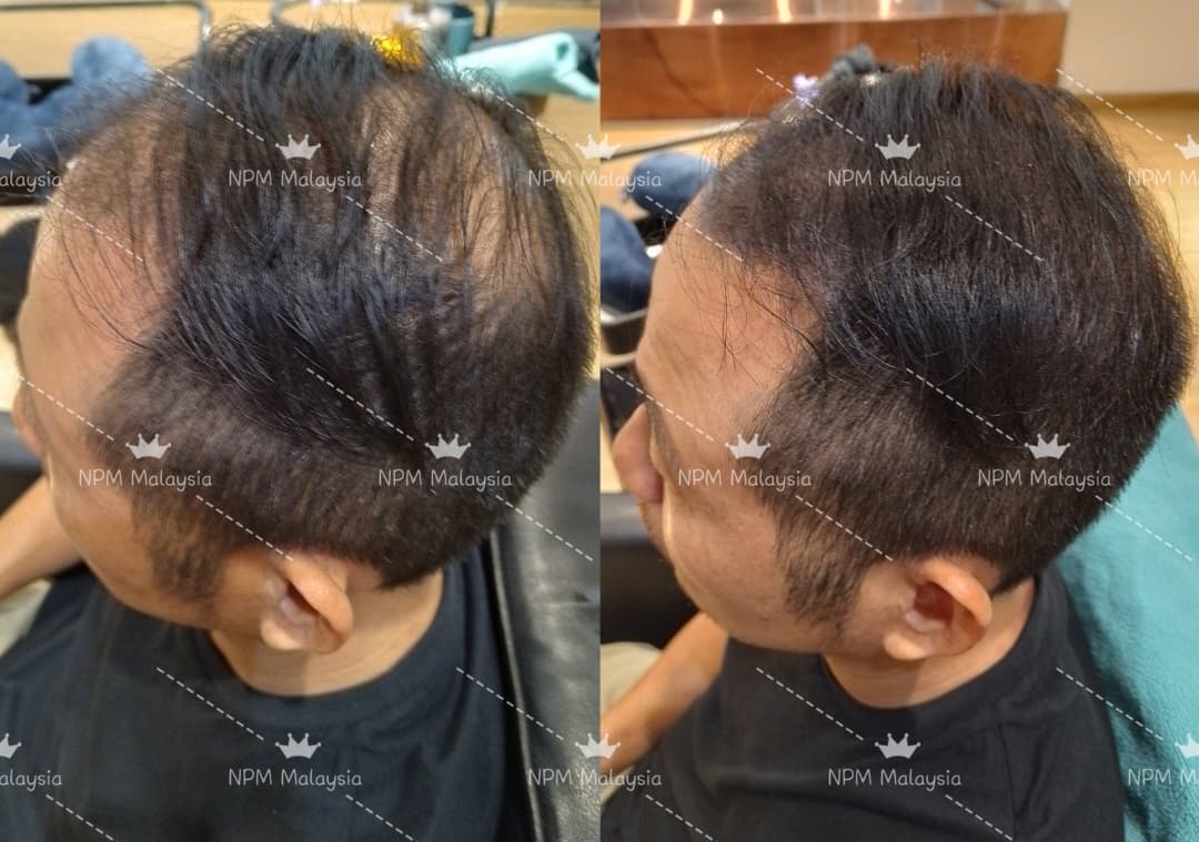 Before and after, crown