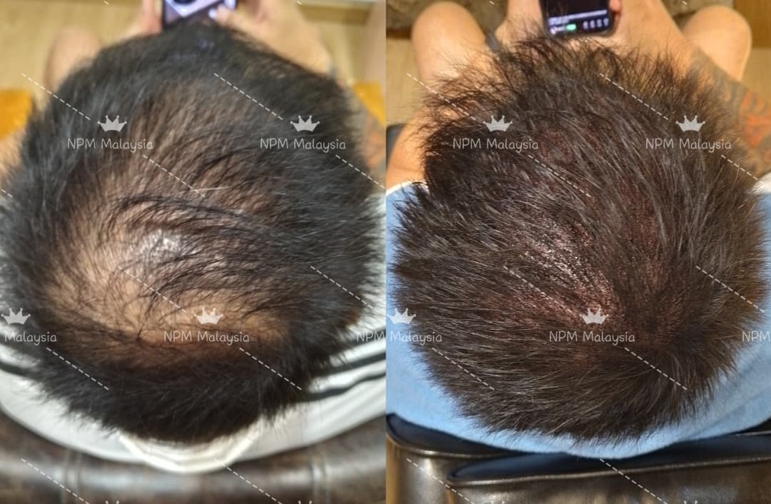 Before and after, top of the head