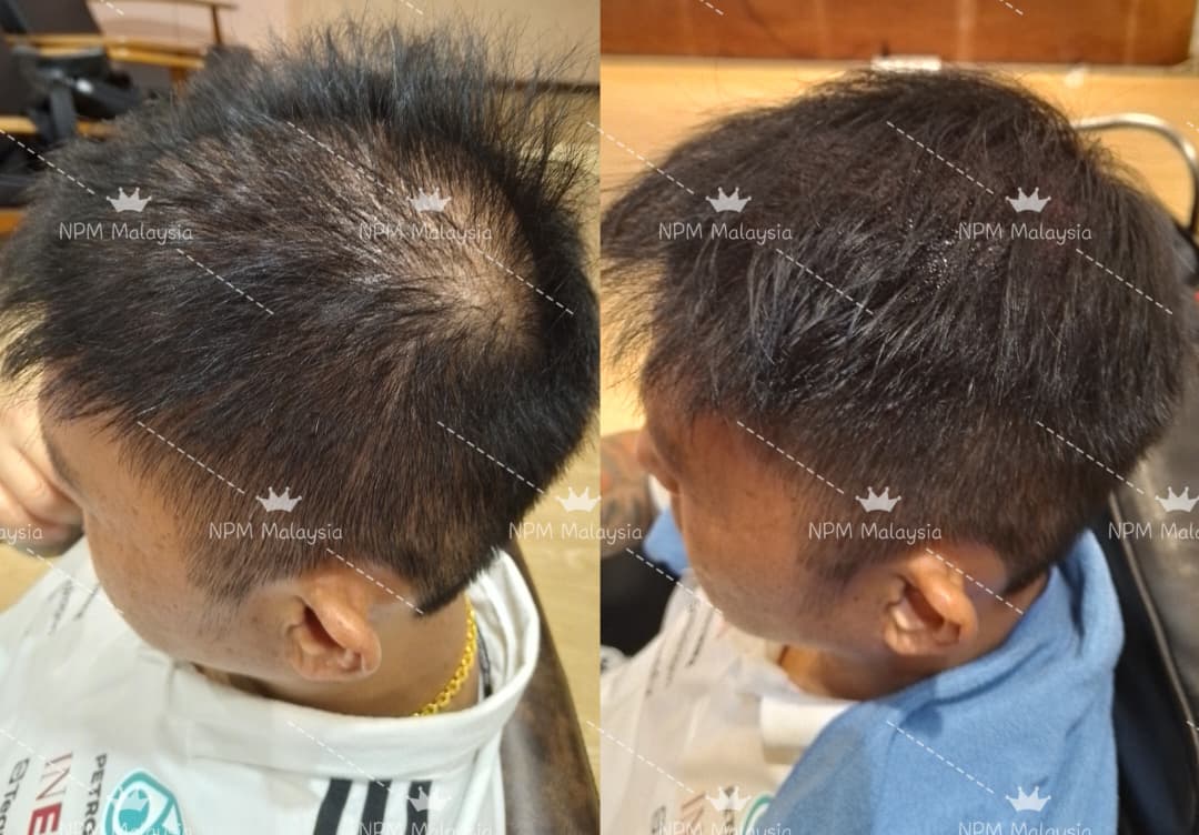 Before and after, crown